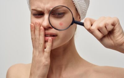 Naturalne sposoby na usuwanie czerwonych blizn po trądziku