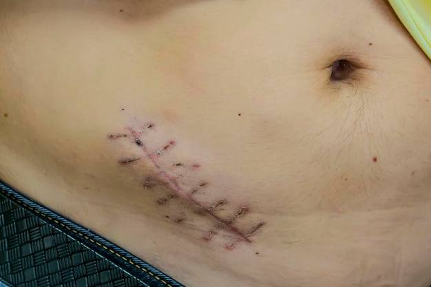 Jak skutecznie zadbać o blizny po operacji?